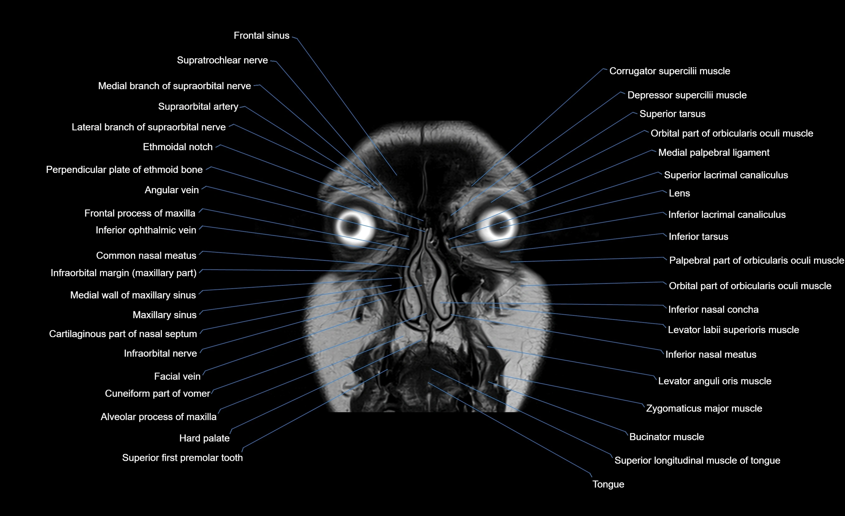 MRI face & paranasal sinuses(PNS) labelled  coronal  cross sectional anatomy 3T radiology  image-img-00001-00014.webp